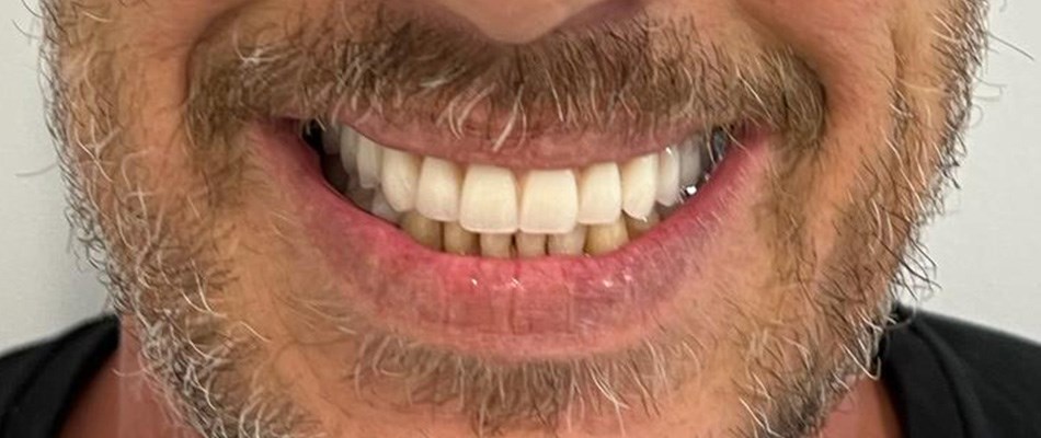 Implante dentário